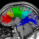 AJNR-Figure4d