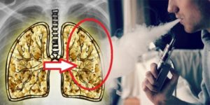 Vaping Lung Disease