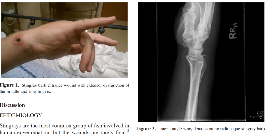 Stingray Envenomation Needs X-rays