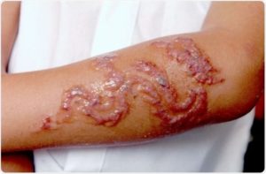 Henna Scarring